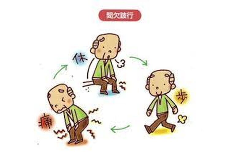 間欠性跛行