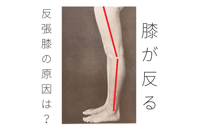 反張膝